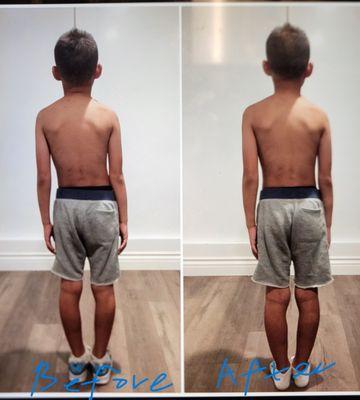 Deformation of a child's body due to poor posture. Before and after treatment.