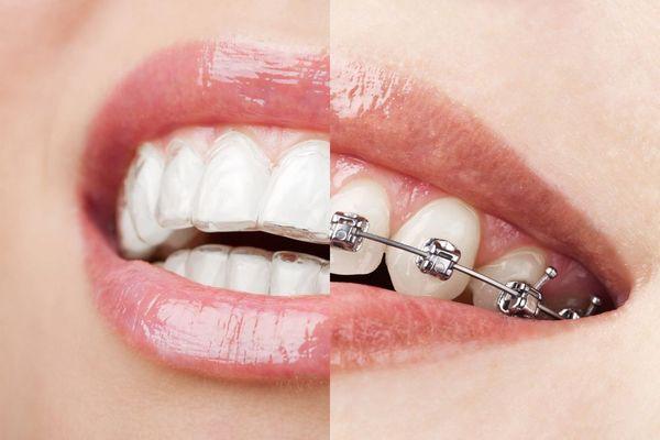 Invisalign VS Braces