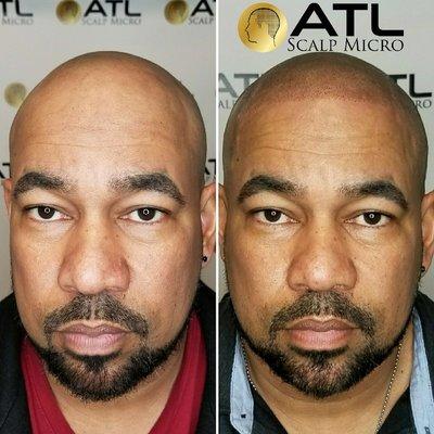 Before and After Scalp Micropigmentation on Black Male at ATL Scalp Micro Atlanta GA