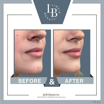 Restylane Kysse 1/2 syringe lip filler augmentation with Botox lip flip at Liquid Beauty Temecula by Dr. DePorto MD.