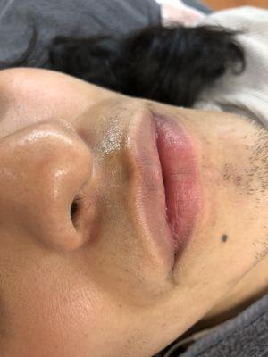 1 treatment upper lip clearance results.