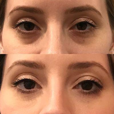 Before and after tear trough filler