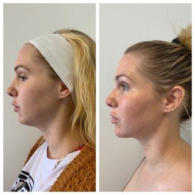 Filler and Kybella jawline transformation by Nurse Summer