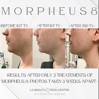 Morpheus8 treatment applied to target and reduce patients double chin fat