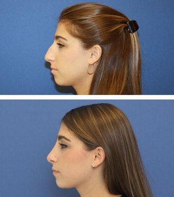 A more smooth and aesthetically pleasing profile is achieved post rhinoplasty