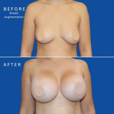 Breast augmentation- Dr. Cheng