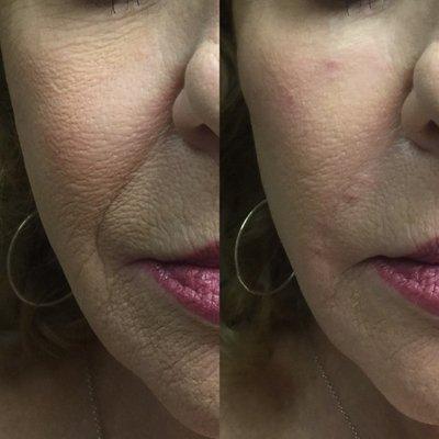 Nasal labial fold before & after