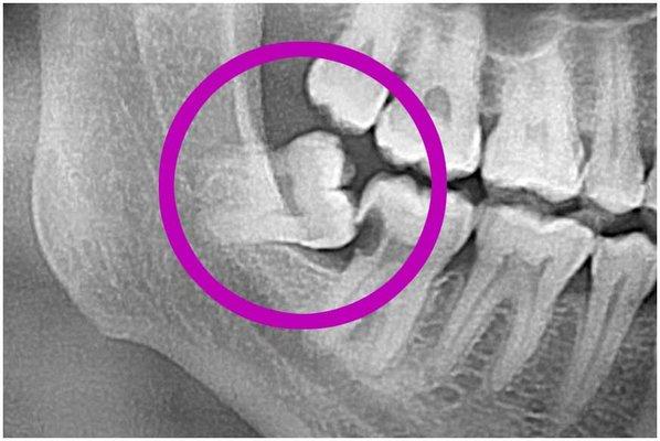 X-ray image of an impacted wisdom tooth.