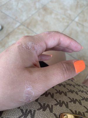 Glue on my hand and no lotion given.