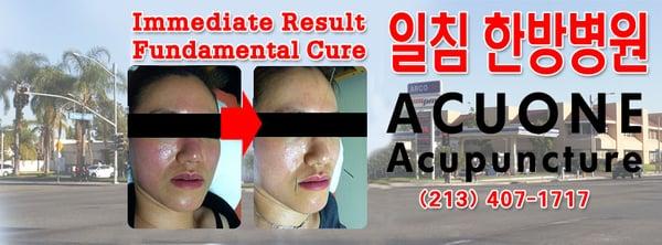 Immediate Result, Fundamental Cure!  Unique Acupuncture Treatment of the Chosun Dynasty(Korean) in the U.S.