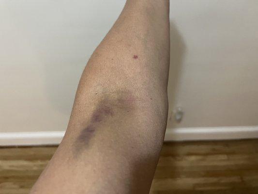 The bruises on my arm 2 days after my blood was drawn