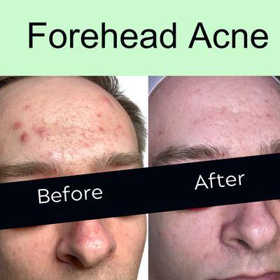 Forehead acne treatment.  Before and after Acne