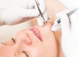 The only PERMANENT hair removal method: electrolysis