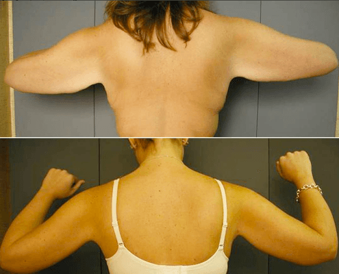 Before and After of arms   after liposuction.