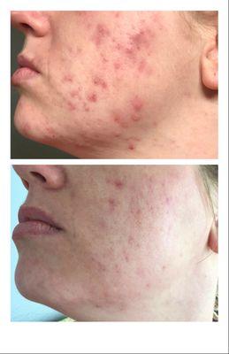 She struggled her whole life and in just a a few short months the Cystic Acne began to heal.