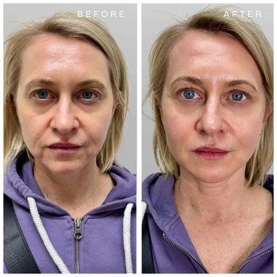 Before and after dermal filler