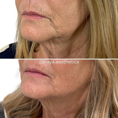 Coolpeel Co2 Laser Resurfacing & Skin Tightening