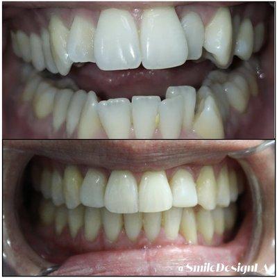 Invisalign Treatment  for our Patient went from severe over crowding to a beautiful smile in 8 months!