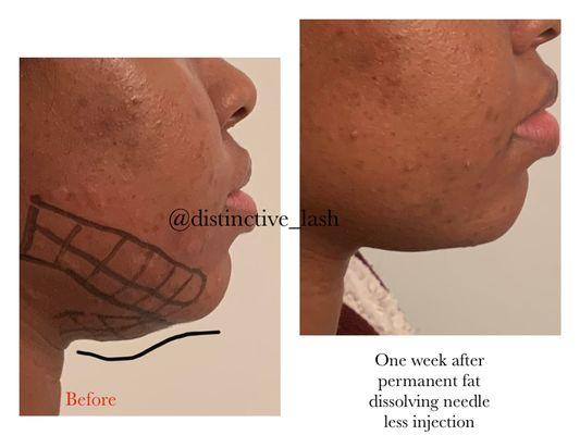 UnderChin NeedleLess PERMANENT fat dissolving injections(think Kybella)