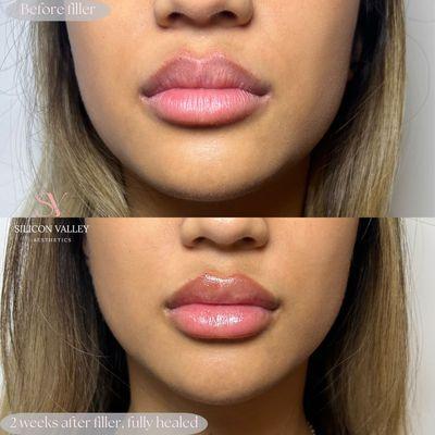 Lip Augmentation by Eva