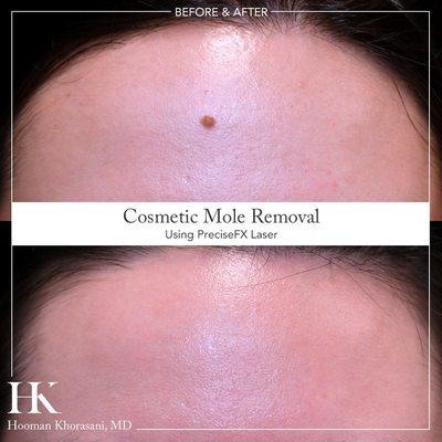 https://www.drkhorasani.com/before-and-after-gallery/cosmetic-mole-removal