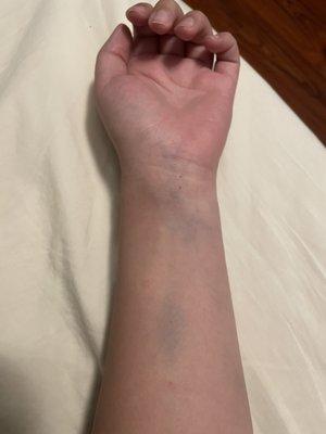 Bruising forming on my left arm...