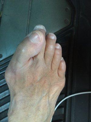 My forever deformed toe. Want to talk about it, Wang?