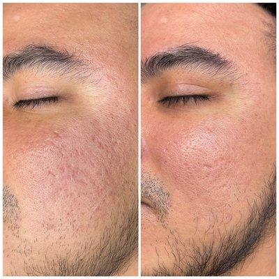 Real results from microneedling!