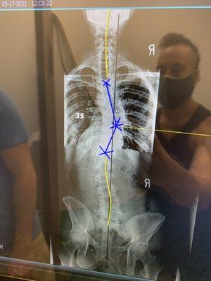 My first x ray. Notice how bad my curves are...