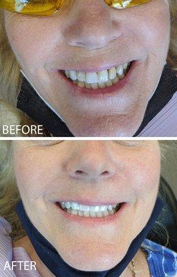 Fixing uneven & discolored teeth with porcelain veneers.