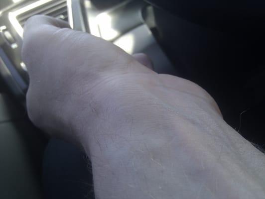 The swelling in my wrist before seeing dr.Bailey