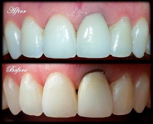 In dentistry, it is fairly challenging to restore only one front tooth and achieve a perfect match. Challenging...But, not impossible!