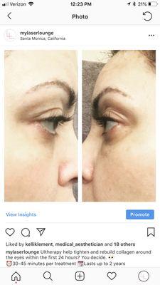 Ultherapy Undereye Rejuvenation