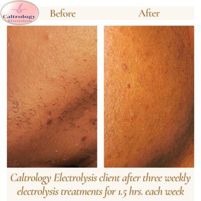 Before & After pictures of Caltrology Electrolysis client