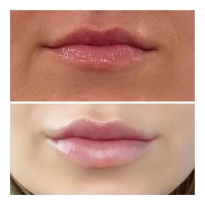 A natural, soft lip enhancement using restylane Kysse.