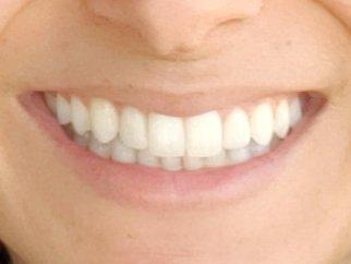 Porcelain veneers (next to front teeth)