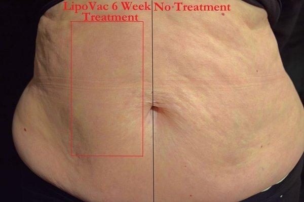 LipoVac Before and After Treatment