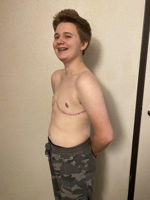 Worst angle of results (3.5 months post-op)