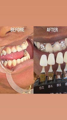 Teeth Whitening