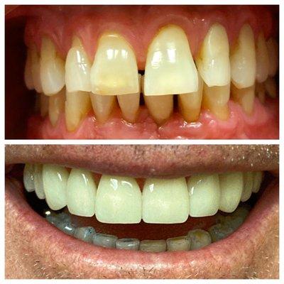 One of our smile transformations!