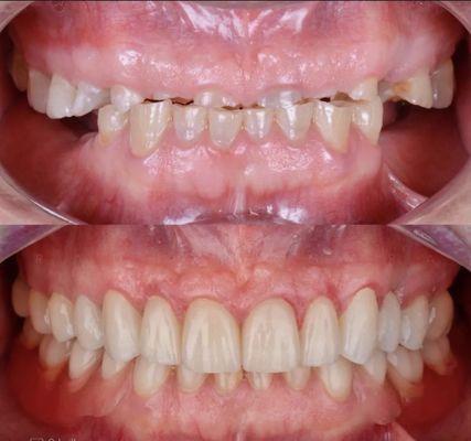 Reconstruction of broken down dentition