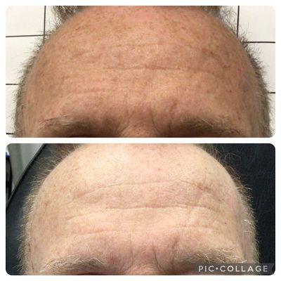 Before and After 1 laser treatment. Look at the reduction in sun damage!