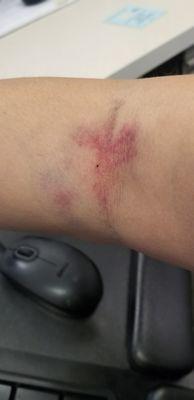 Bruised up arm after donation