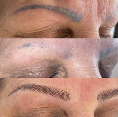 Tattoo removal, microblading