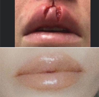 Dr. Song saved my lips... only one that could.sorry I know the top photo is graphic but the bottom was a month after...Thank you. 10 stars