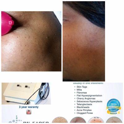 Satisfied client 15 days after her Skin Classic treatment.