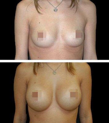 Breast Augmentation