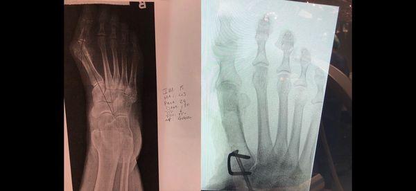 Base osteotomy for bunion correction. Before and after images.