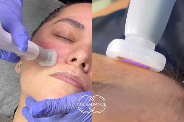 Jet Plasma Treatment