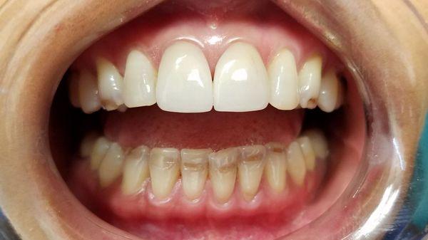 BEFORE:  patient wasn't happy with her smile, and wanted to finally do something about it.